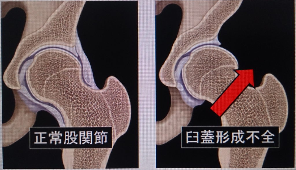 一過性の滑膜炎や化膿性関節炎はどのように治療されますか?