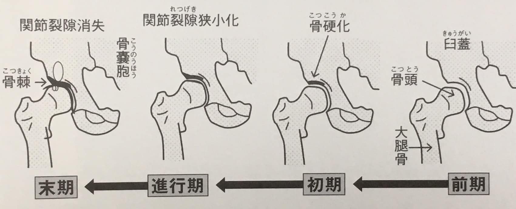 変股症の一般的な病期