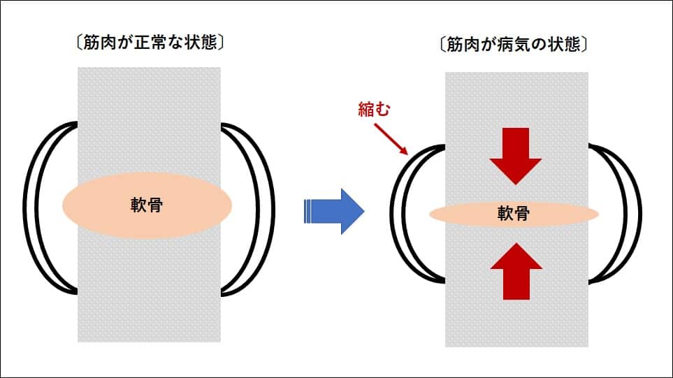 股関節の模式図